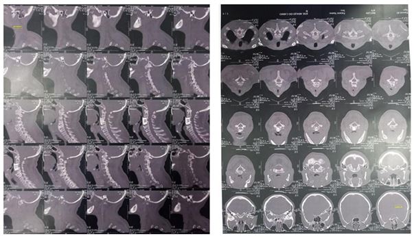 Figura 1. Imagens de tomografia computadorizada cervical revelam artrodese mecânica em corpo de C3-C4, com cage intradiscal neste nível, além de fratura compressiva no aspecto lateral à direita do corpo de C1. Landri Sales, Piauí, Brasil, 2022.